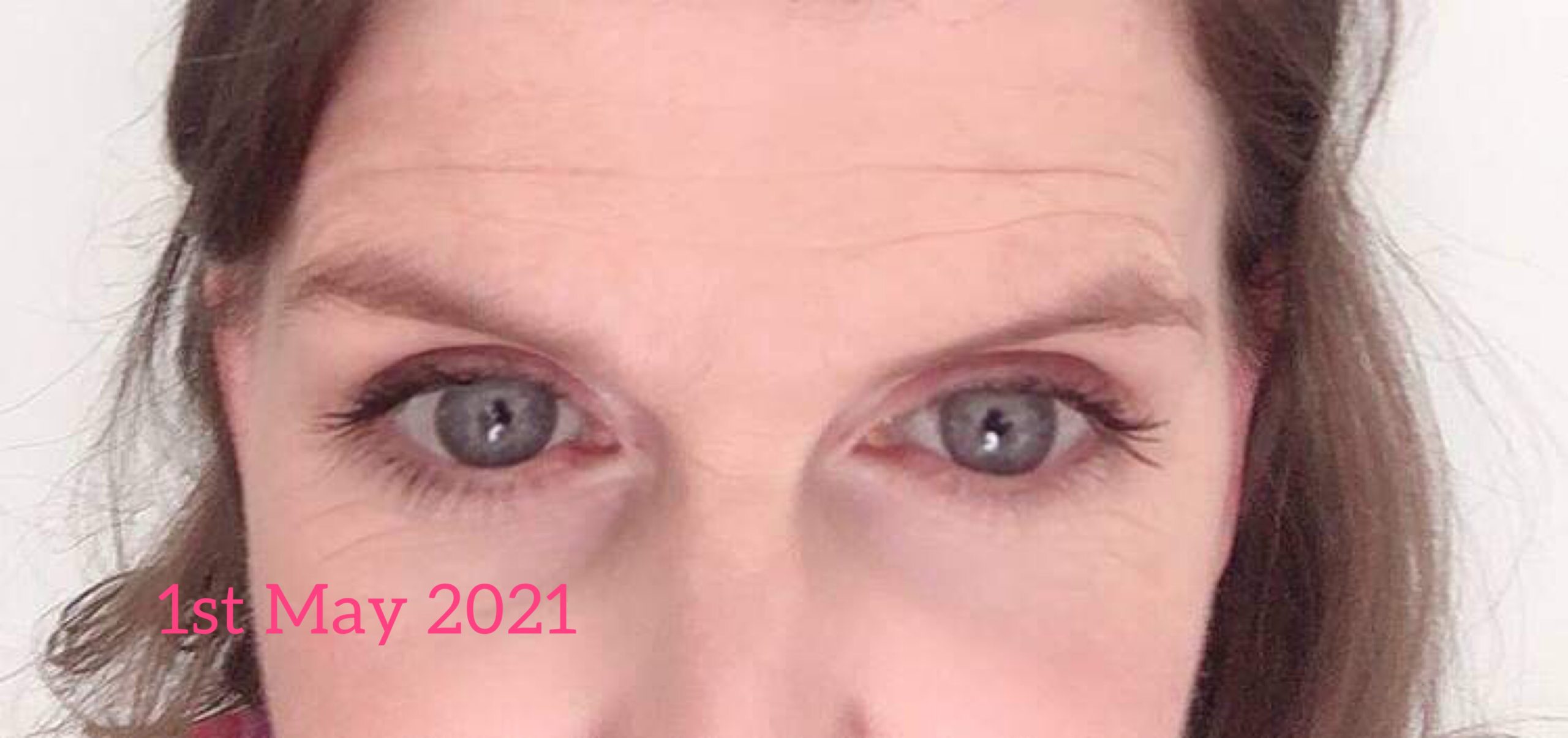 forehead lines before face yoga