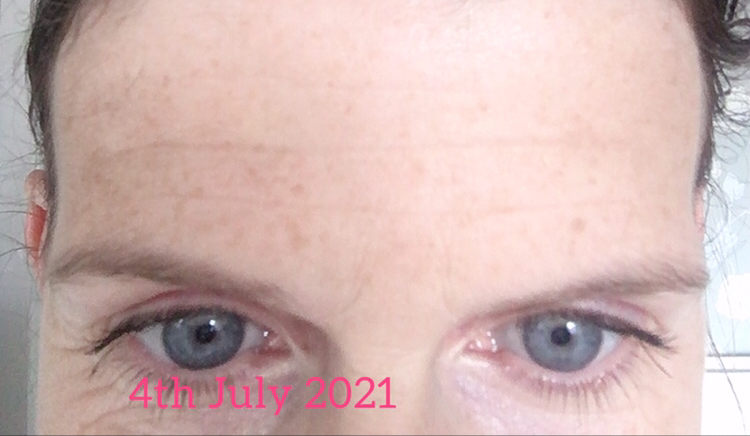 forehead lines after face yoga