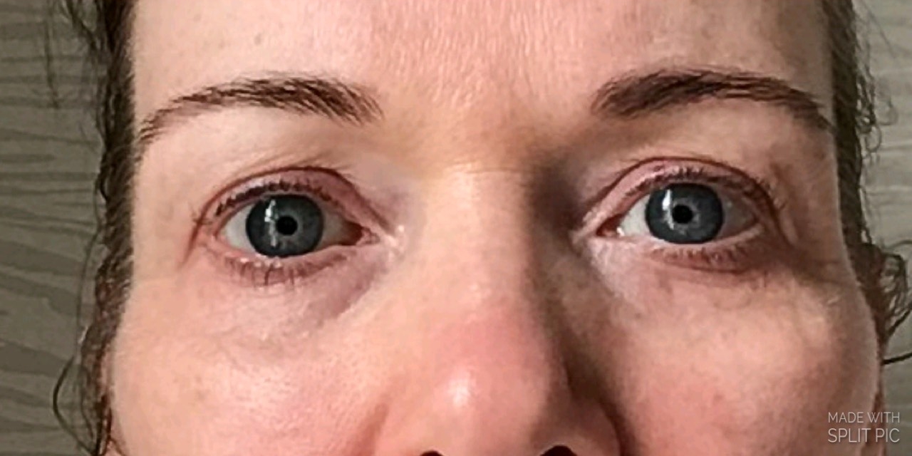 face yoga eyes progress picture